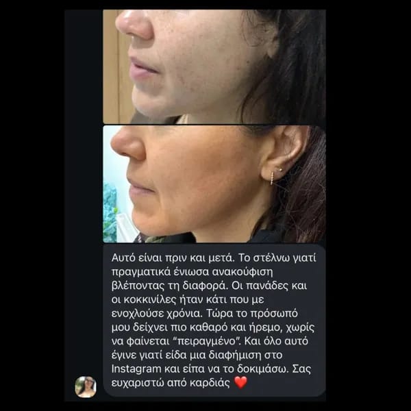 Customer photo review of Labbok Skin Lightening Cream, 30ml