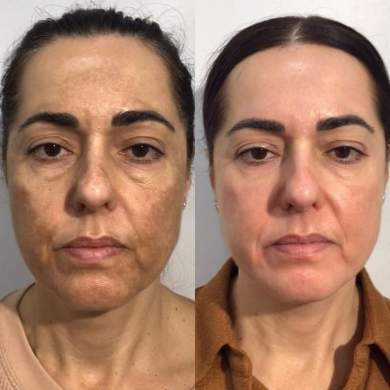 Customer photo review of Bálsamo Anti Melasma. Reduce manchas en 7 días