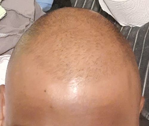 Customer photo review of Minoxidil+DHT Blocker Solution - MEN ONLY, 3x60ml pack