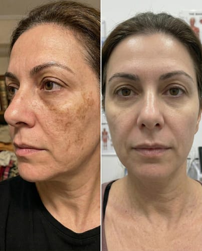 Customer photo review of Labbok Peptides Skin Lightening Combo Box