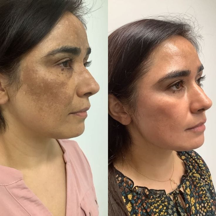 Customer photo review of Bálsamo Anti Melasma. Reduce manchas en 7 días
