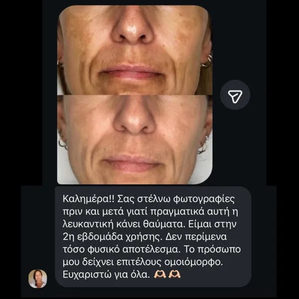 Customer photo review of Labbok Skin Lightening Cream, 30ml