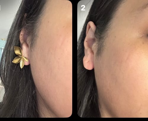 Close-up comparison of a customer's ear with the gold Mira Earring on the left and without on the right, showing its coverage.