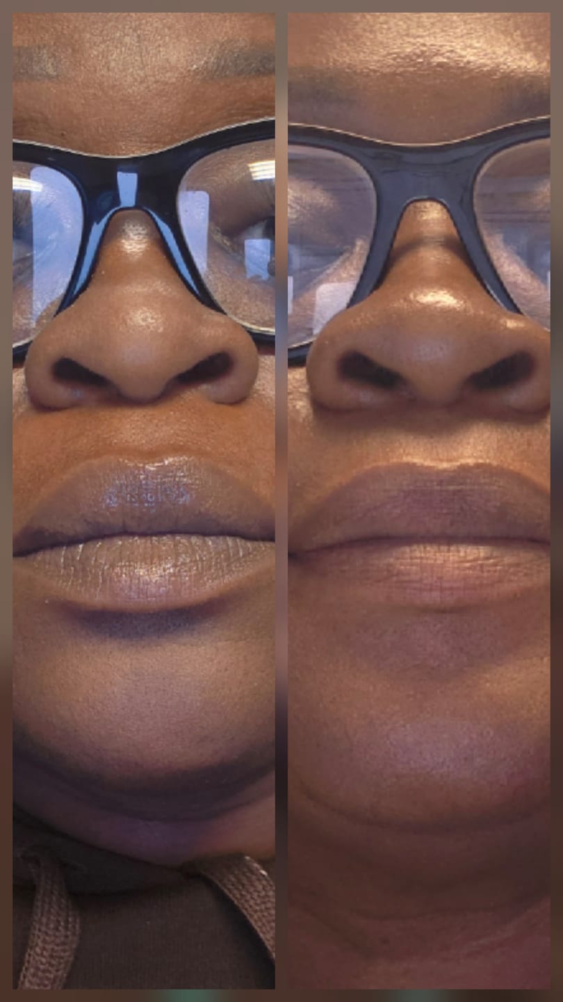 Customer photo review of Lips Lightening Cream For Men and Women (Results in 5 Days or Less)