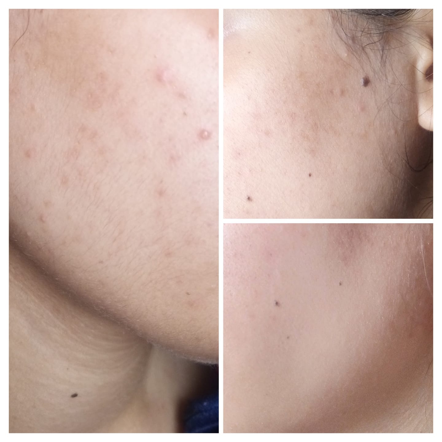Customer photo review of MandelAC Cream