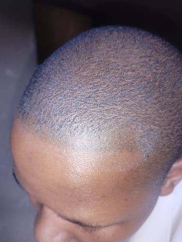 Customer photo review of Minoxidil+DHT Blocker Solution - MEN ONLY, 3x60ml pack