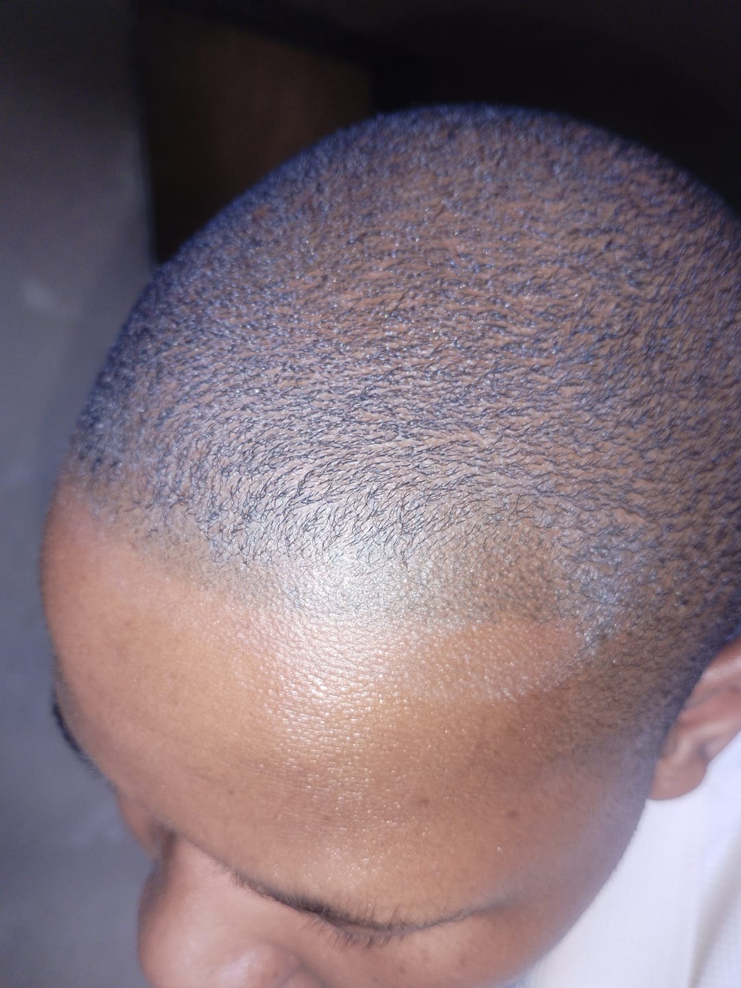 Customer photo review of Minoxidil+DHT Blocker Solution - MEN ONLY, 3x60ml pack