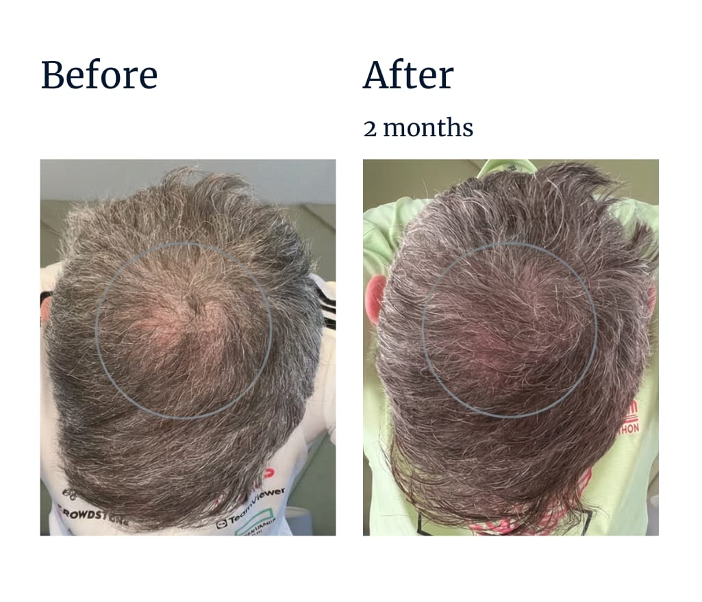 Customer photo review of LIVDOR Pro Laser Hair Growth Cap