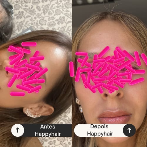 Cliente mostrando o resultado do Happy Hair. À esquerda, a testa com entradas. À direita, a testa com cabelo novo e cheio.