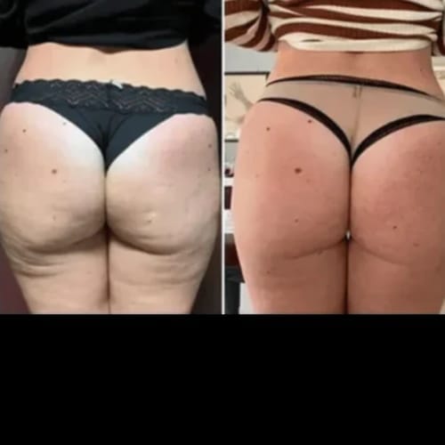Customer photo review of Anti Cellulite Leggings - Den permanente løsningen på cellulitter