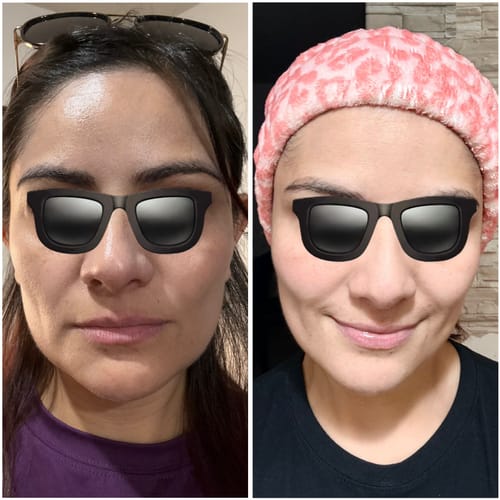 Customer photo review of INIA GLACE Dispositivo Facial 7 en 1 de Microcorriente Gua Sha