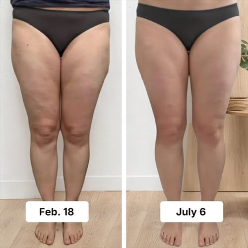 Customer photo review of Anti Cellulite Leggings - Den permanente løsningen på cellulitter