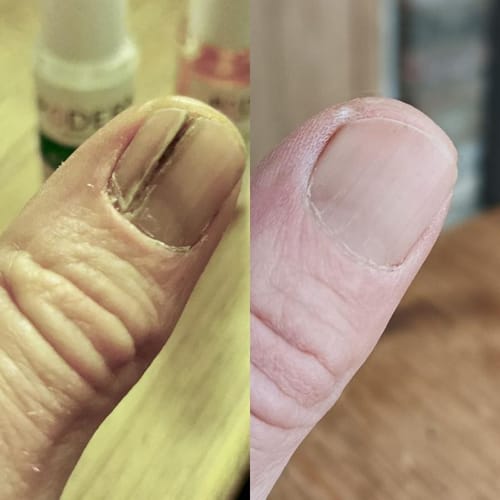 Customer photo review of VitaeCharm NailShield Anti-Fungal Stick