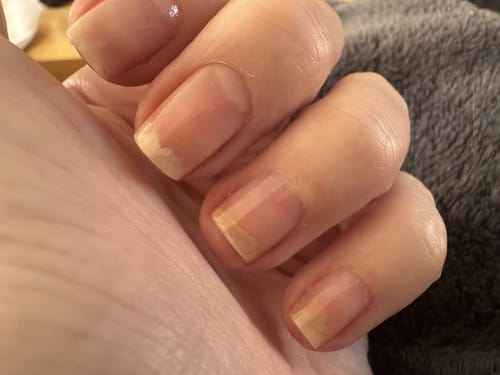 Customer photo review of VitaeCharm NailShield Anti-Fungal Stick