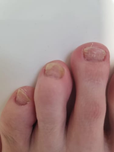 Customer photo review of VitaeCharm NailShield Anti-Fungal Stick