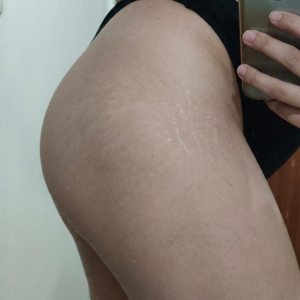 Customer photo review of SKYNN Ремоделиращ Стик за Белези™
