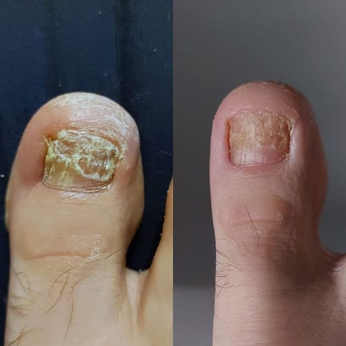 Customer photo review of VitaeCharm NailShield Anti-Fungal Stick