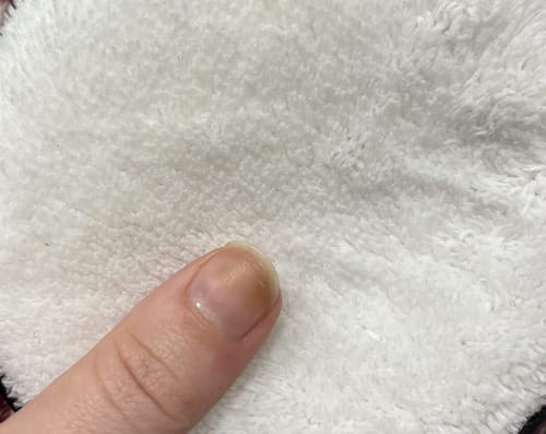 Customer photo review of VitaeCharm NailShield Anti-Fungal Stick
