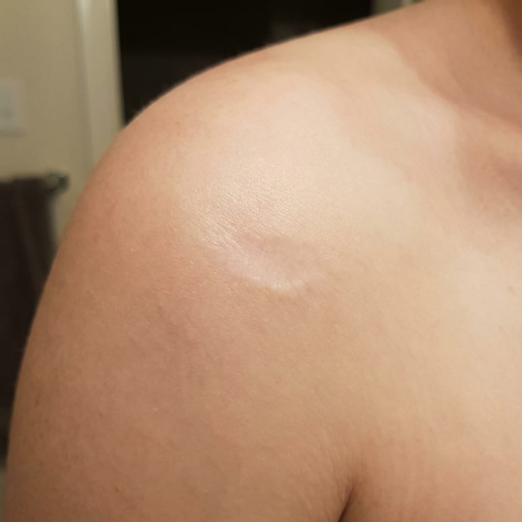 Customer photo review of SKYNN Ремоделиращ Стик за Белези™