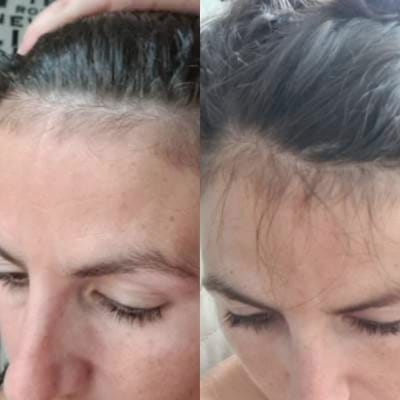 Customer photo review of Sérum de croissance pour cheveux (1 mois)