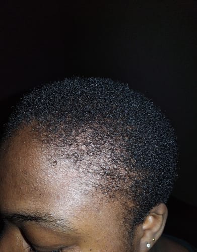 Customer photo review of Minoxidil 5% SOLUTION, 3x60ml pack