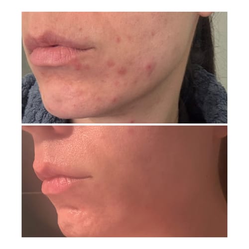 Customer's before and after photo showing reduced acne on the chin and jawline after using the Advanced Acne Program™.