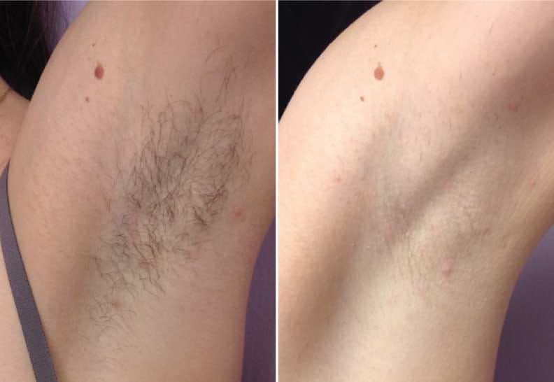 Customer photo review of OroSkin Ultra Sapphire IPL Hair Removal Handset