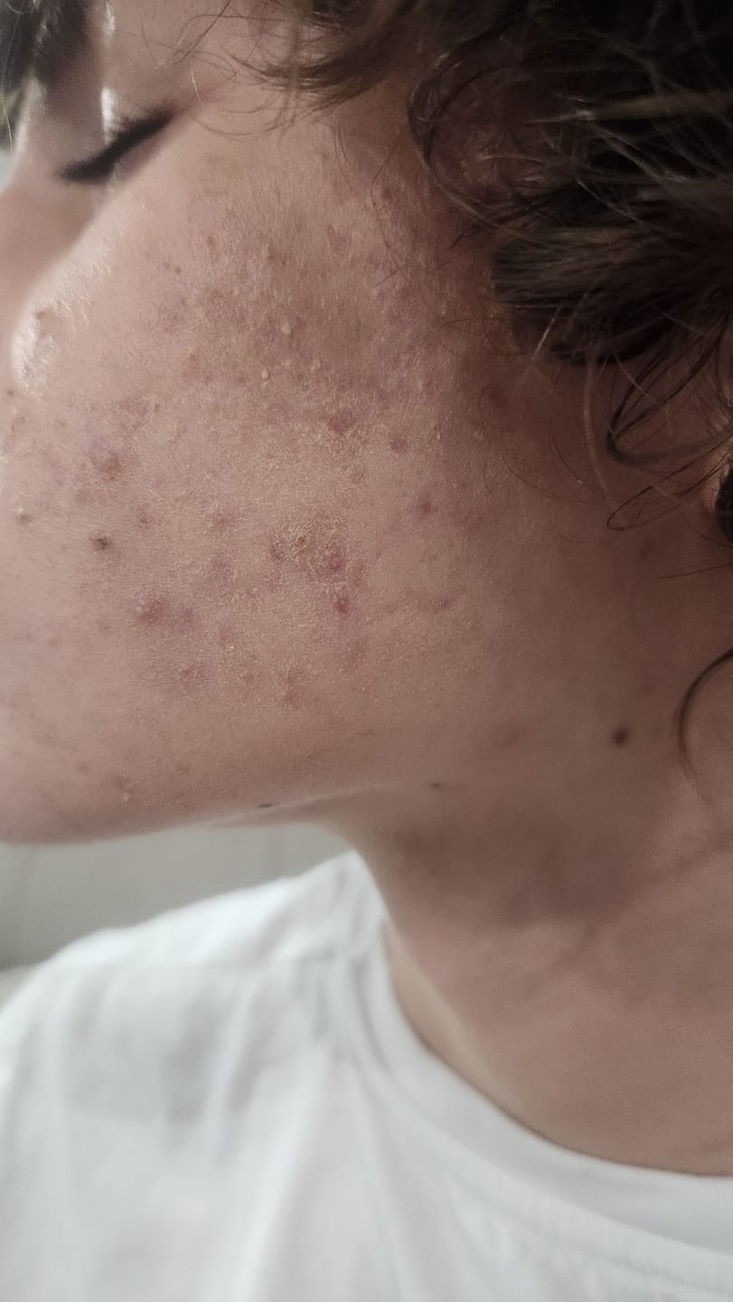 Customer photo review of Acne Drying Lotion Plus (1.8% Encapsulated Salicylic Acid) — 20 mL