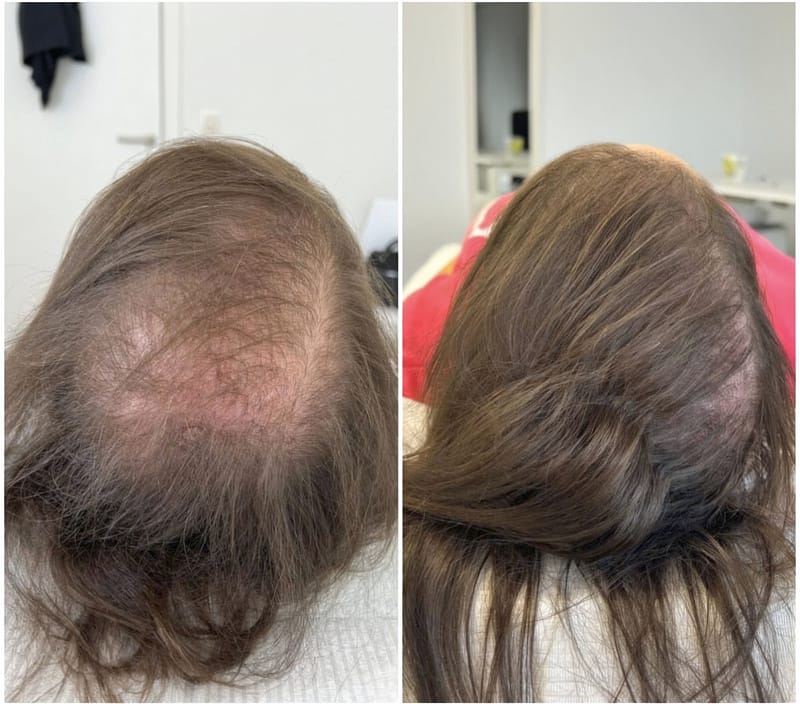 Customer photo review of Sérum de croissance pour cheveux (3 mois)