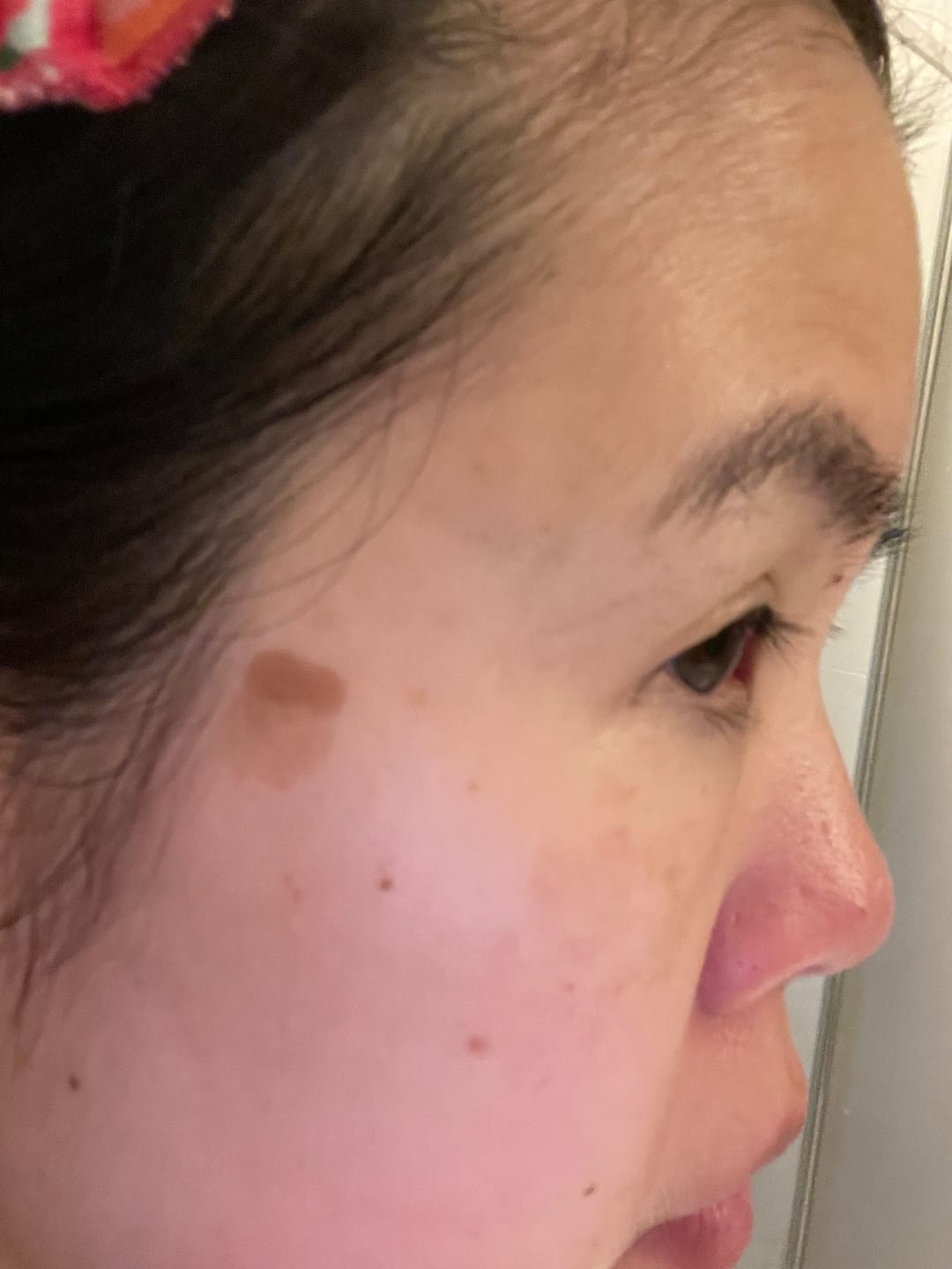 Customer photo review of MAGNESIUM SUPER STICK - skin tags, moles, keratosis & stubborn blemishes
