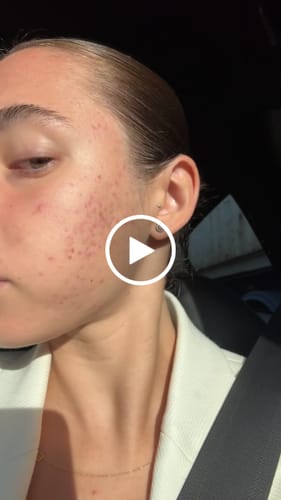 Customer video review of Intermediate Acne Program™