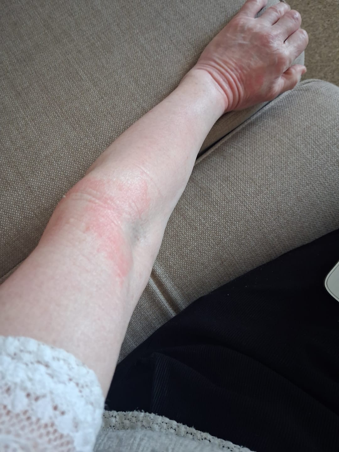 Customer photo review of Bioskin Zeoderm Skin Repair Moisturiser