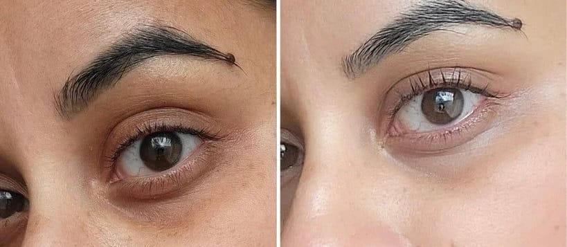 Customer photo review of Eye Roller | Eliminates Dark Circles & Puffy Eyes