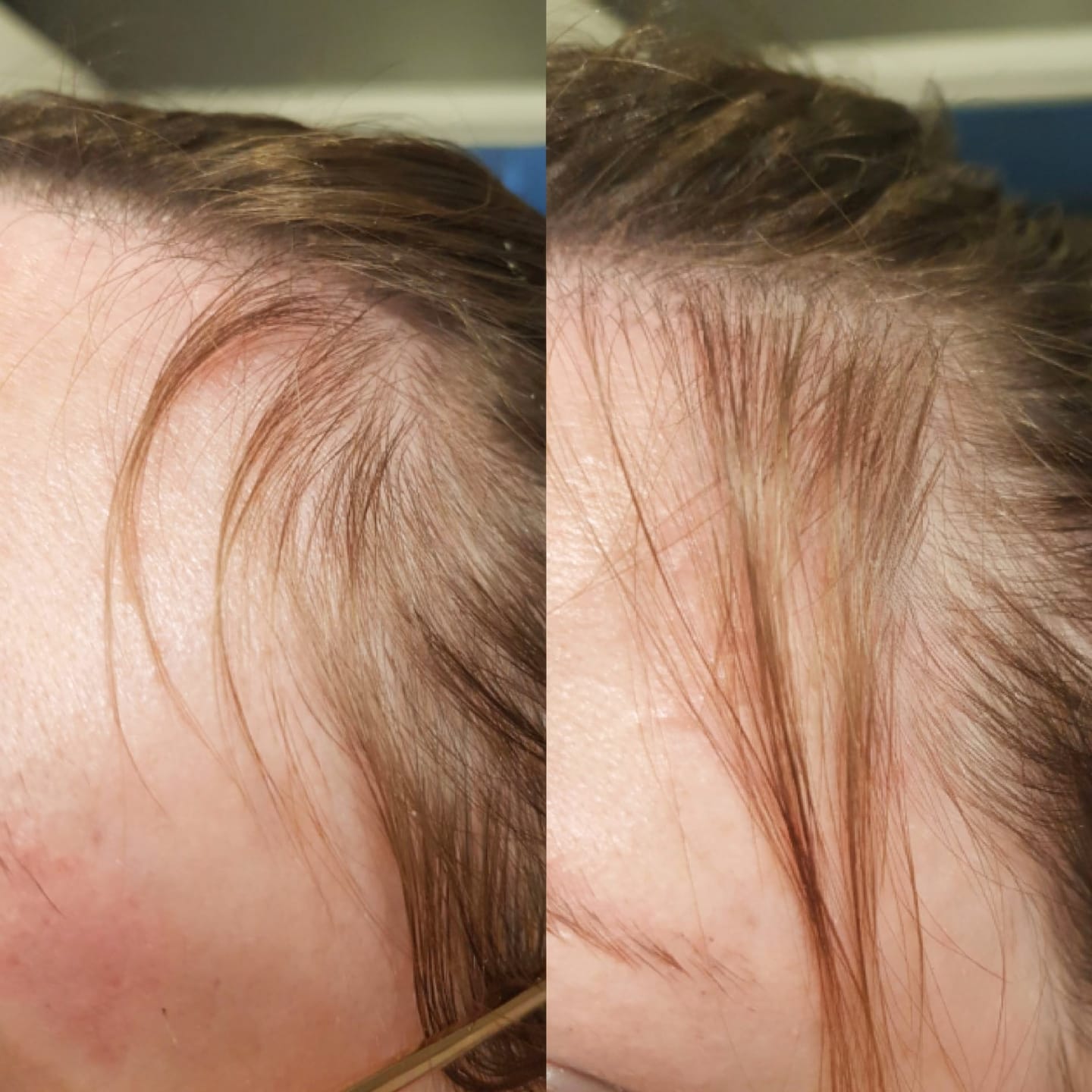 Customer photo review of Sérum de croissance pour cheveux (3 mois)