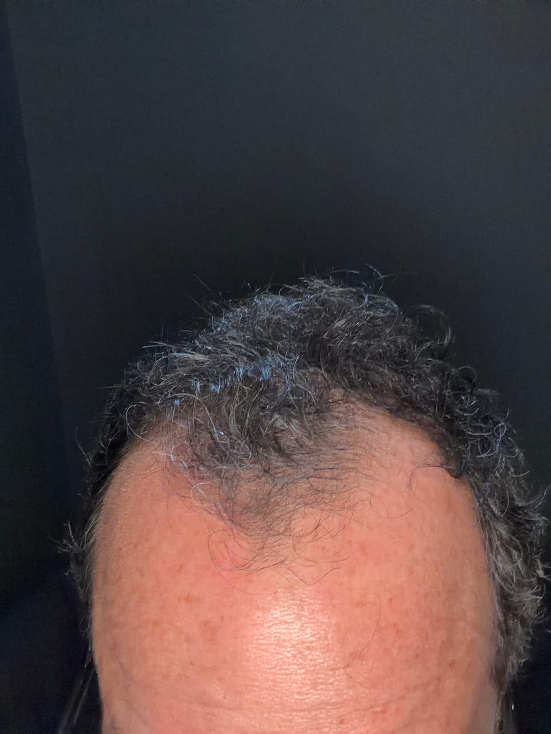 Customer photo review of SÉRUM CAPILLAIRE MULTI ACTIF BIO-DENSYL®