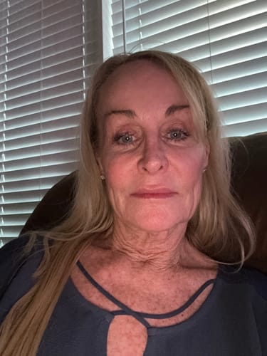 Reviewer photo showing the skin on their face, neck, and chest after using the Micro Infusion System.