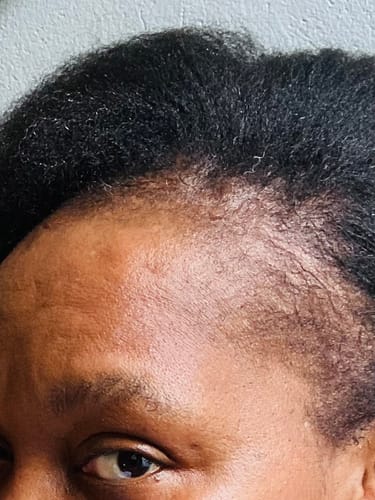 Customer photo review of Minoxidil5% Solution, 1 Pack 60ml