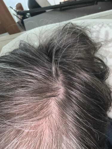 Reviewer's close-up photo of their scalp, showing thinning dark and grey hair.