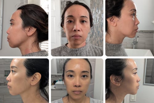 Customer photo review of EvenSkyn® Lumo⁺ Skin Tightening Handset