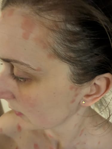 Customer shows a psoriasis flare-up on their face and neck before taking the Multi Strain Biotic.