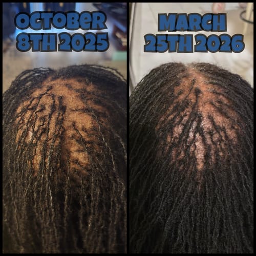 Reviewer's before-and-after image of their crown, showing new hair growth after using Rennora Hair Growth Serum.