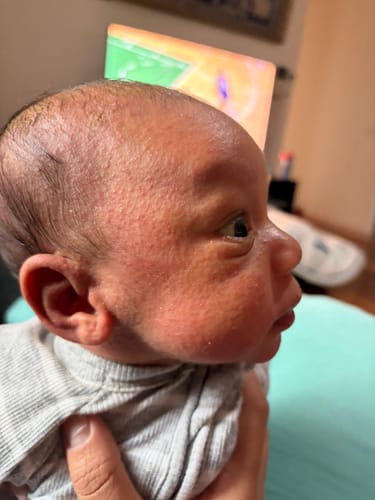 Customer's side-view photo of a baby's red, bumpy skin before using Hemp Seed Butter.