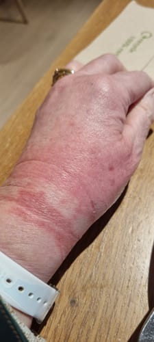 Customer's burned hand and wrist showing red, inflamed skin before using Calm Balm.
