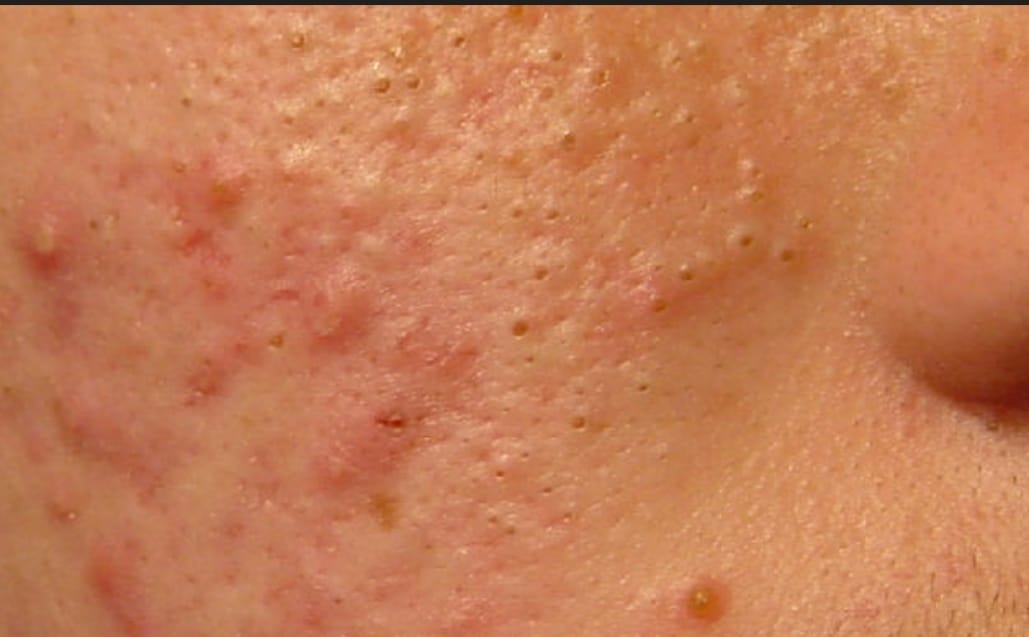 Customer photo review of Kill Acne & Redness Ritual