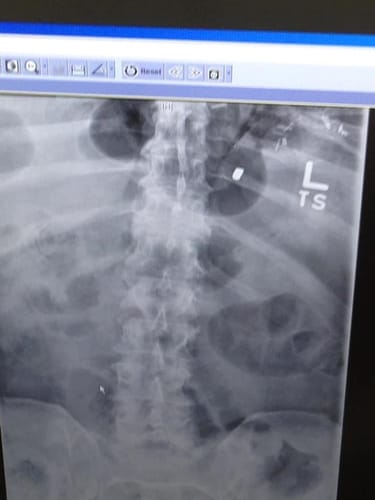 Reviewer shares an X-ray showing a bullet, providing context for their use of Royal Cherry for pain control.