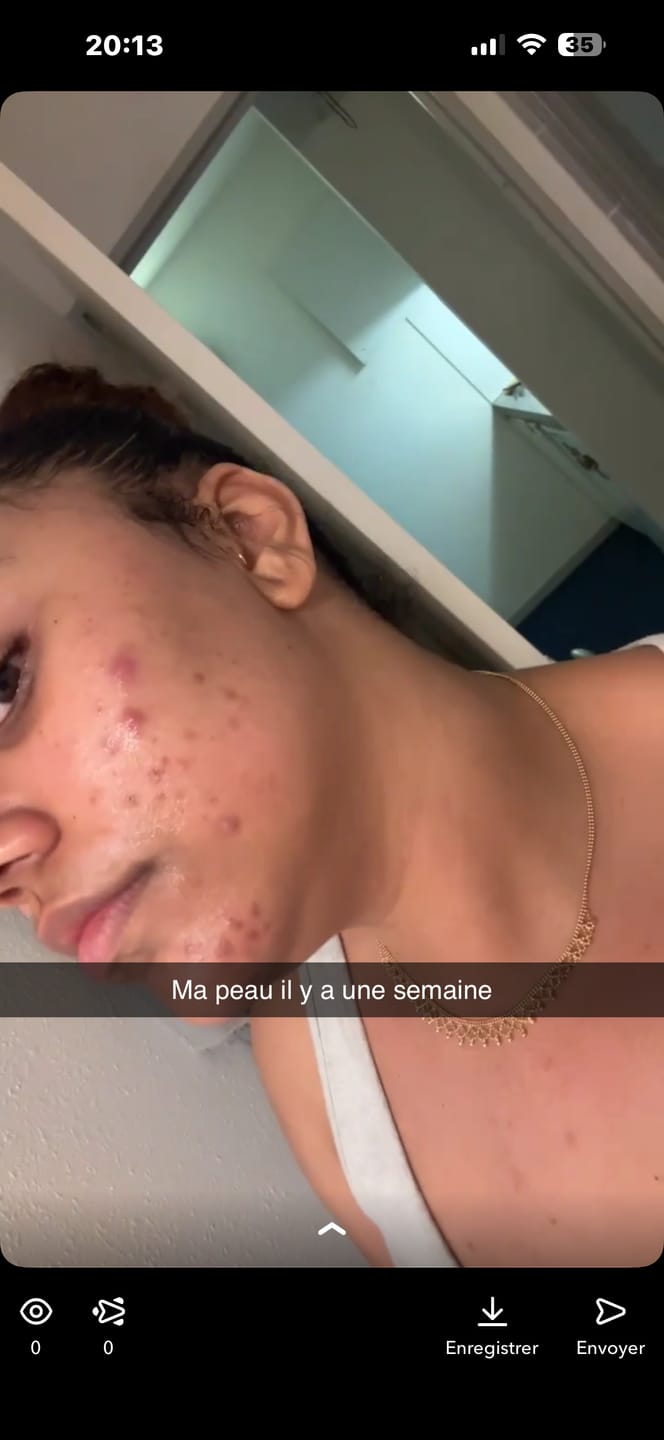 Customer photo review of Anua - Sérum - Niacinamide 10% + TXA 4% Serum