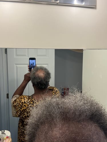 Reviewer showing hair regrowth on a previously bald crown after using Rennora Hair Growth Serum.