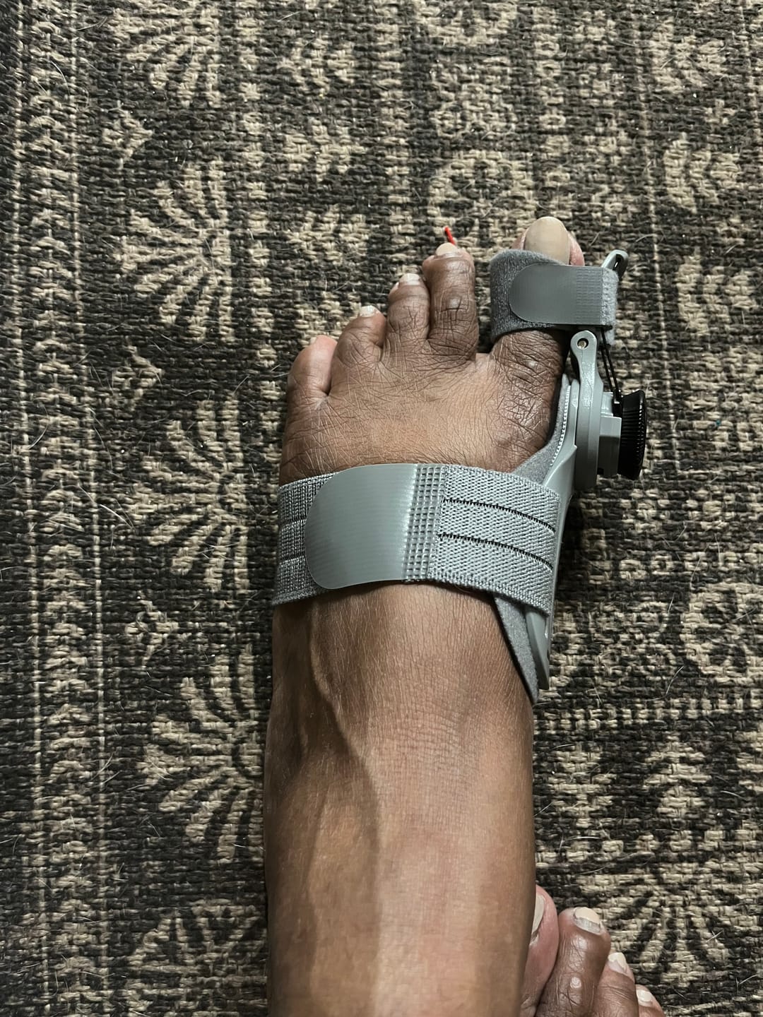 Customer photo review of Treatmedy™ Bunion Fix