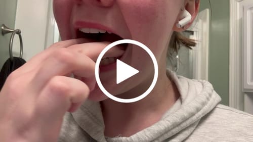 Customer video review of Upper and Lower Retainers Set