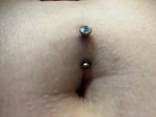 Customer photo review of Ultimate Keloid Scar Trio